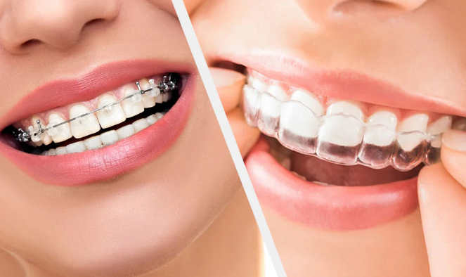 Benefits when you start using clear aligners than traditional braces